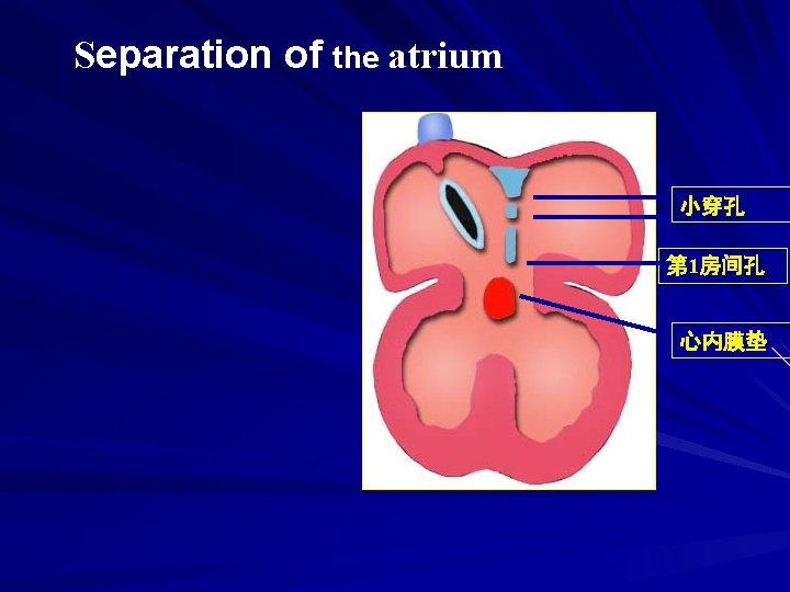 Separation of the atrium 小穿孔 第 1房间孔 心内膜垫 