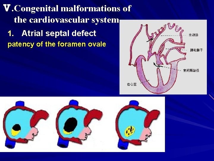 Ⅴ. Congenital malformations of the cardiovascular system 1. Atrial septal defect patency of the