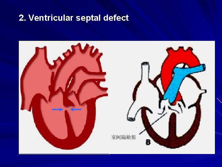 2. Ventricular septal defect 