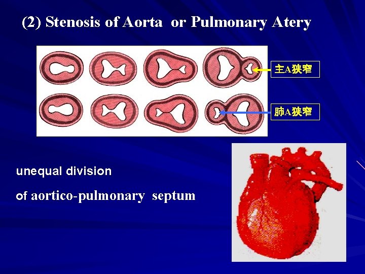 (2) Stenosis of Aorta or Pulmonary Atery 主A狭窄 肺A狭窄 unequal division of aortico-pulmonary septum