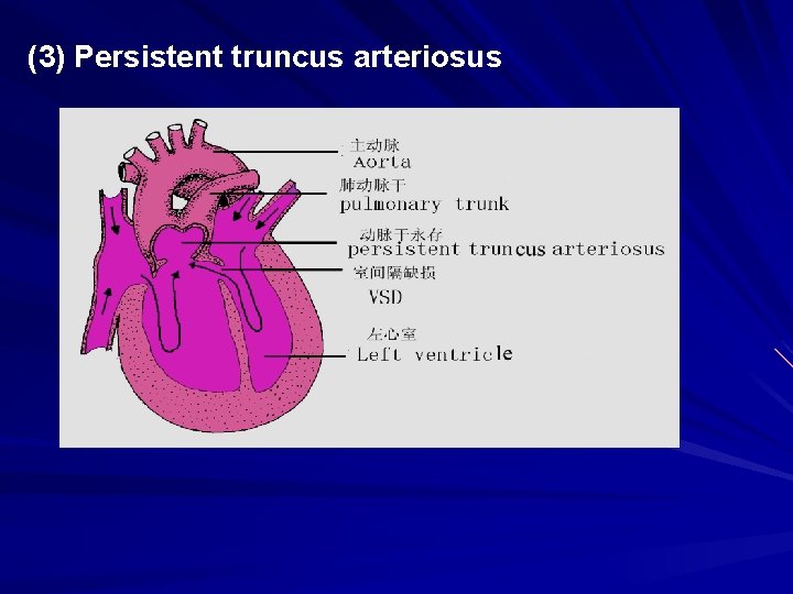 (3) Persistent truncus arteriosus 