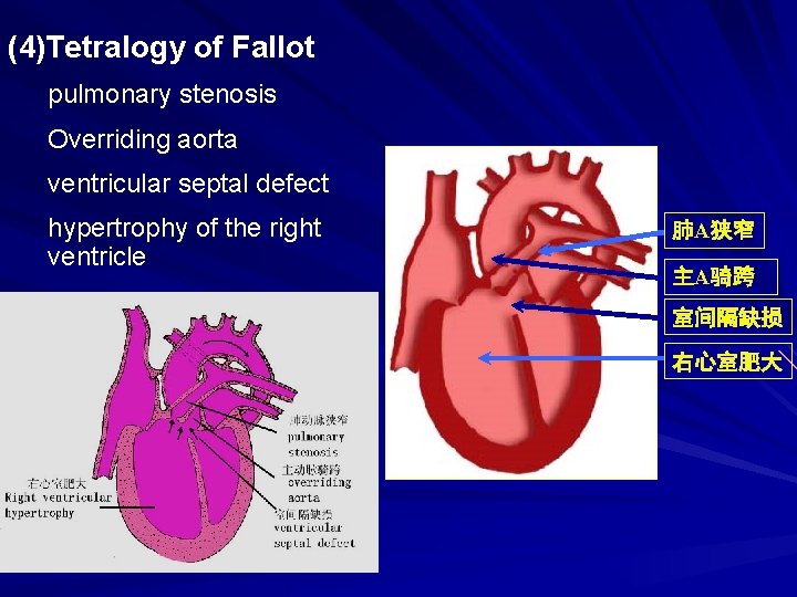 (4)Tetralogy of Fallot pulmonary stenosis Overriding aorta ventricular septal defect hypertrophy of the right