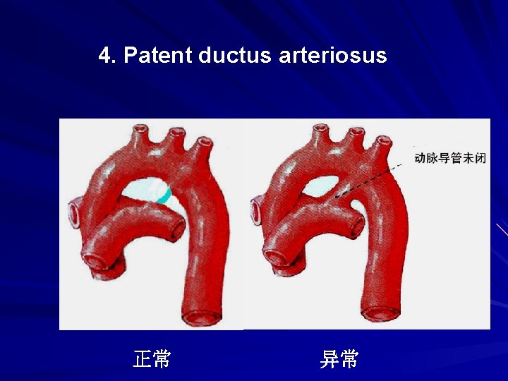 4. Patent ductus arteriosus 正常 异常 