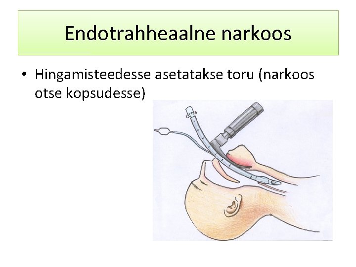 Endotrahheaalne narkoos • Hingamisteedesse asetatakse toru (narkoos otse kopsudesse) 