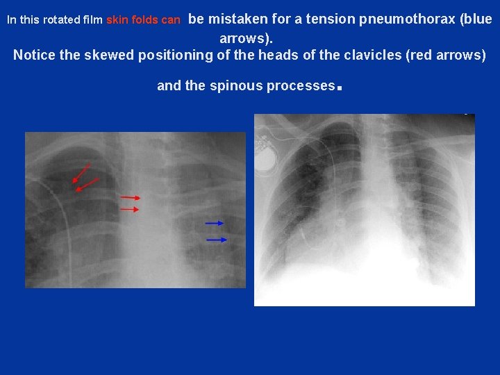 be mistaken for a tension pneumothorax (blue arrows). Notice the skewed positioning of the