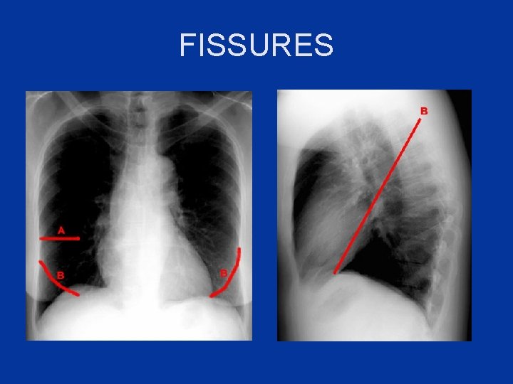 FISSURES 