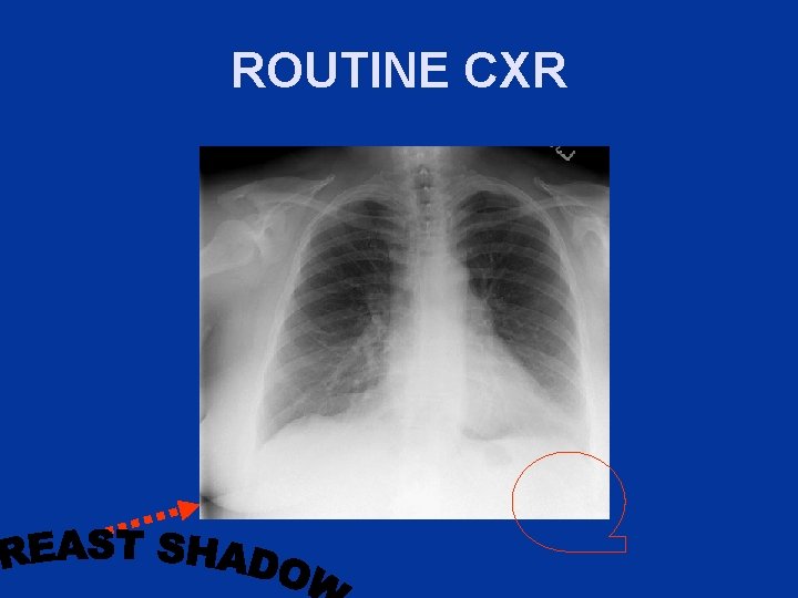 ROUTINE CXR 