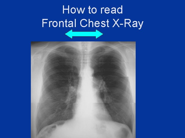 How to read Frontal Chest X-Ray 