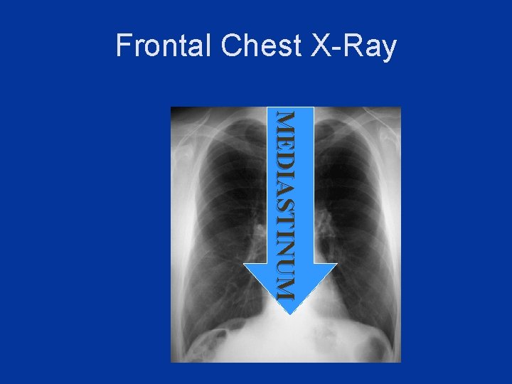 Frontal Chest X-Ray M E DIAST INUM 
