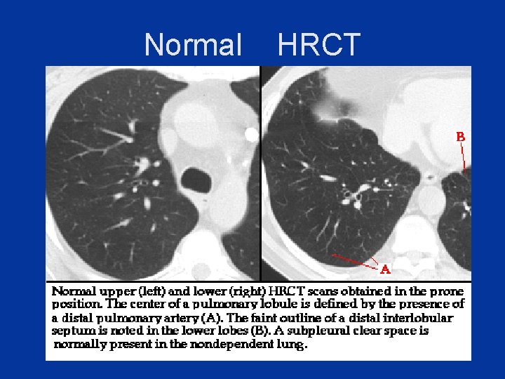 Normal HRCT 