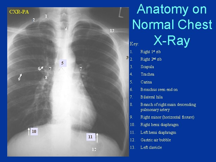 CXR-PA 1 22 4 13 Anatomy on Normal Chest X-Ray Key: 5 6 7