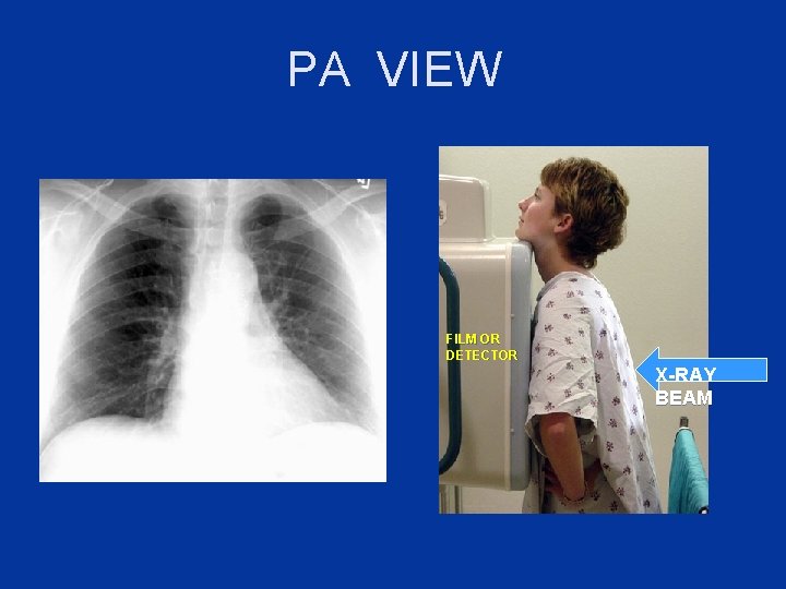 PA VIEW FILM OR DETECTOR X-RAY BEAM 