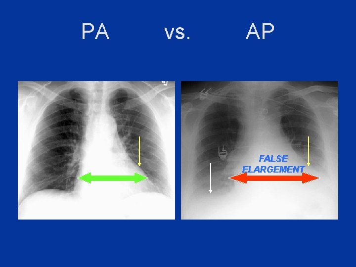 PA vs. AP FALSE ELARGEMENT 