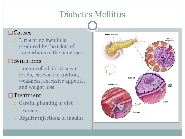 Diabetes Mellitus � Causes Little or no insulin is produced by the islets of