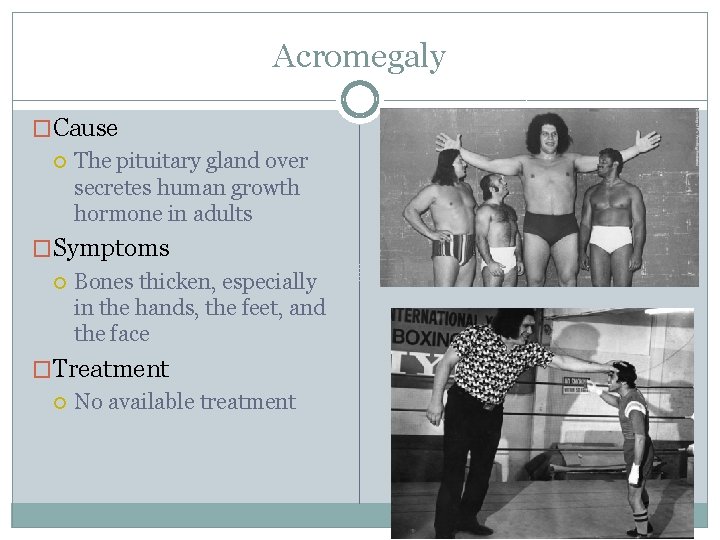 Acromegaly �Cause The pituitary gland over secretes human growth hormone in adults �Symptoms Bones