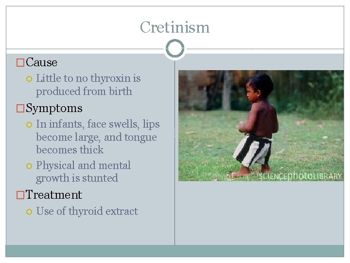 Cretinism �Cause Little to no thyroxin is produced from birth �Symptoms In infants, face