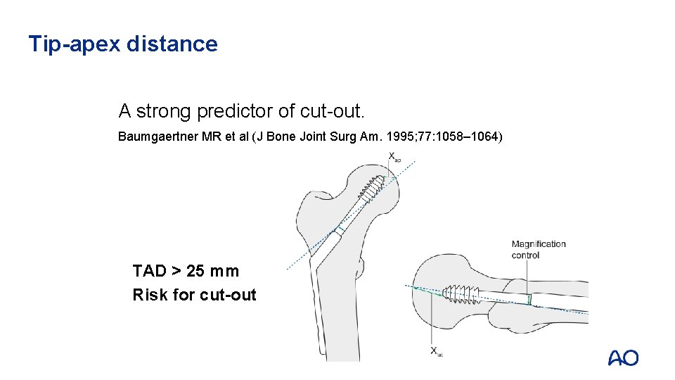 Tip-apex distance A strong predictor of cut-out. Baumgaertner MR et al (J Bone Joint