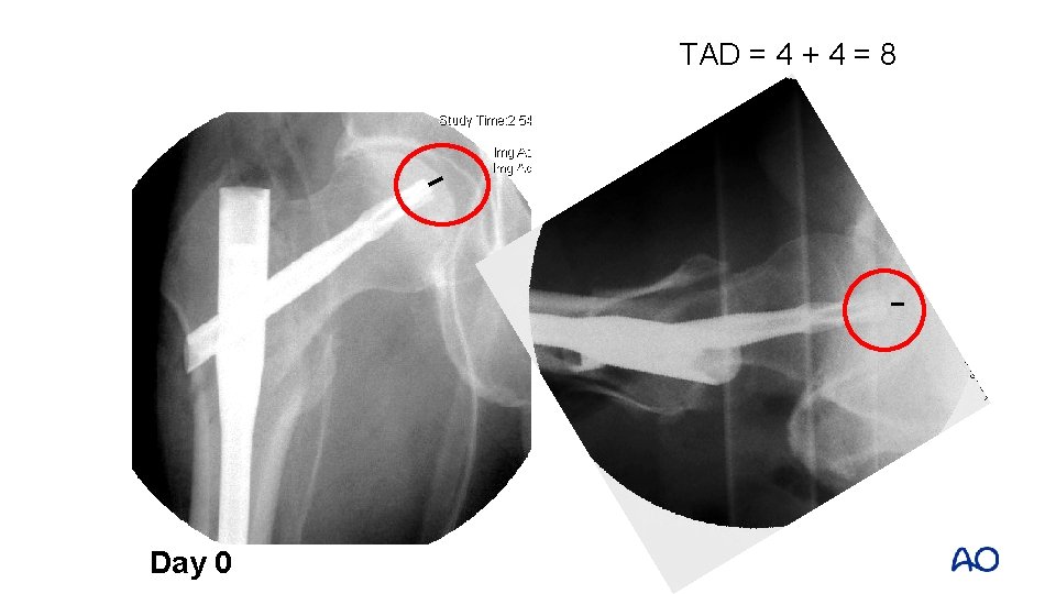 TAD = 4 + 4 = 8 Day 0 