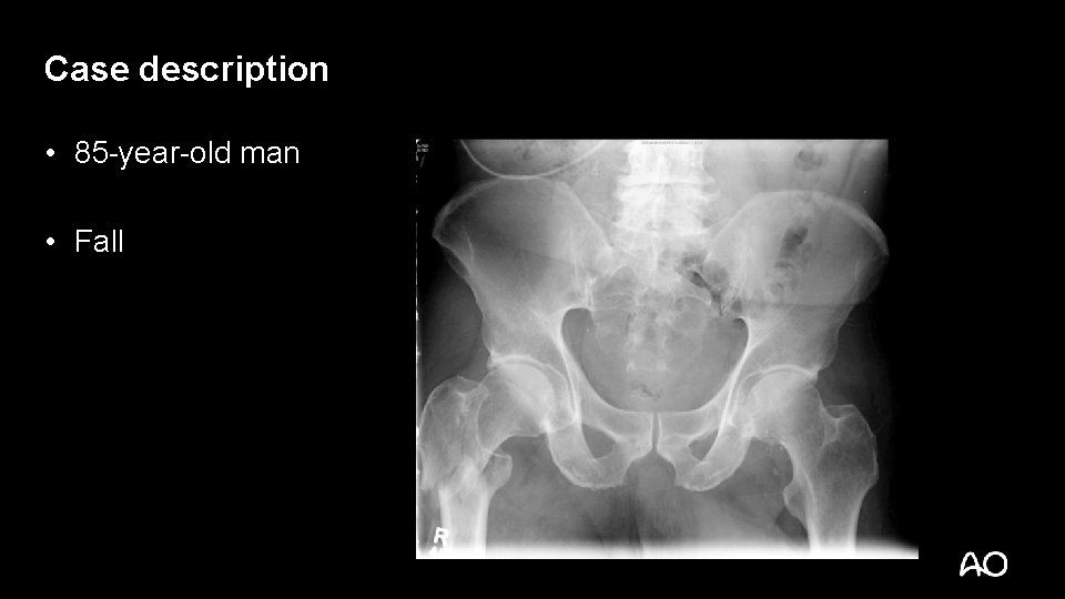 Case description • 85 -year-old man • Fall 