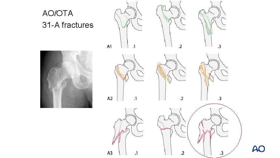 AO/OTA 31 -A fractures 