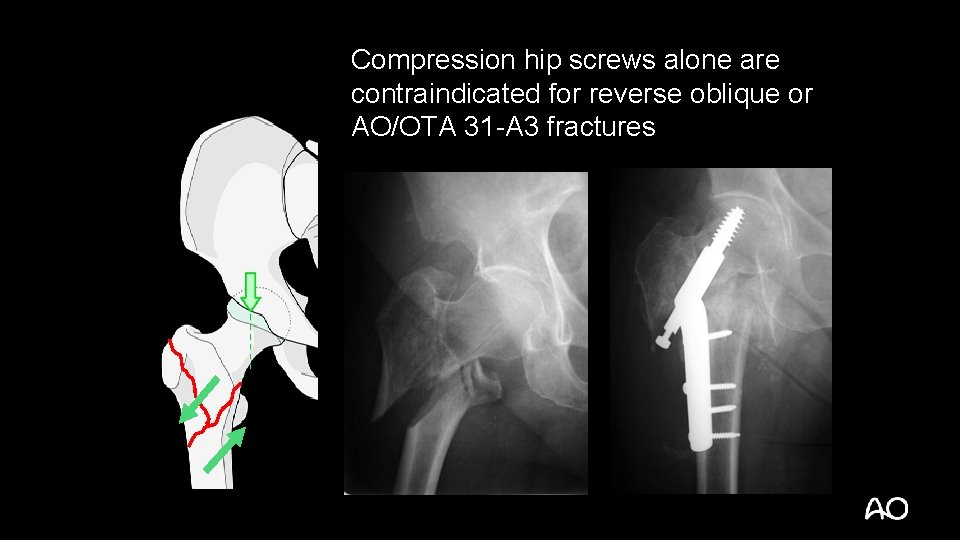 Compression hip screws alone are contraindicated for reverse oblique or AO/OTA 31 -A 3