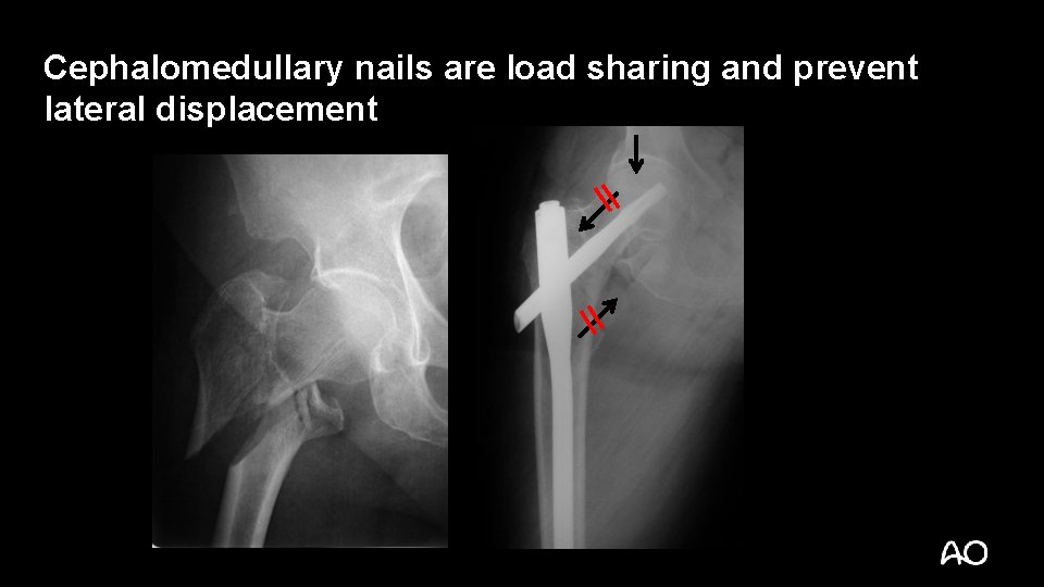 Cephalomedullary nails are load sharing and prevent lateral displacement 
