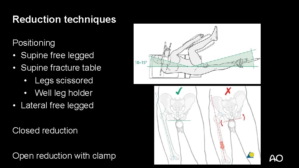 Reduction techniques Positioning • Supine free legged • Supine fracture table • Legs scissored