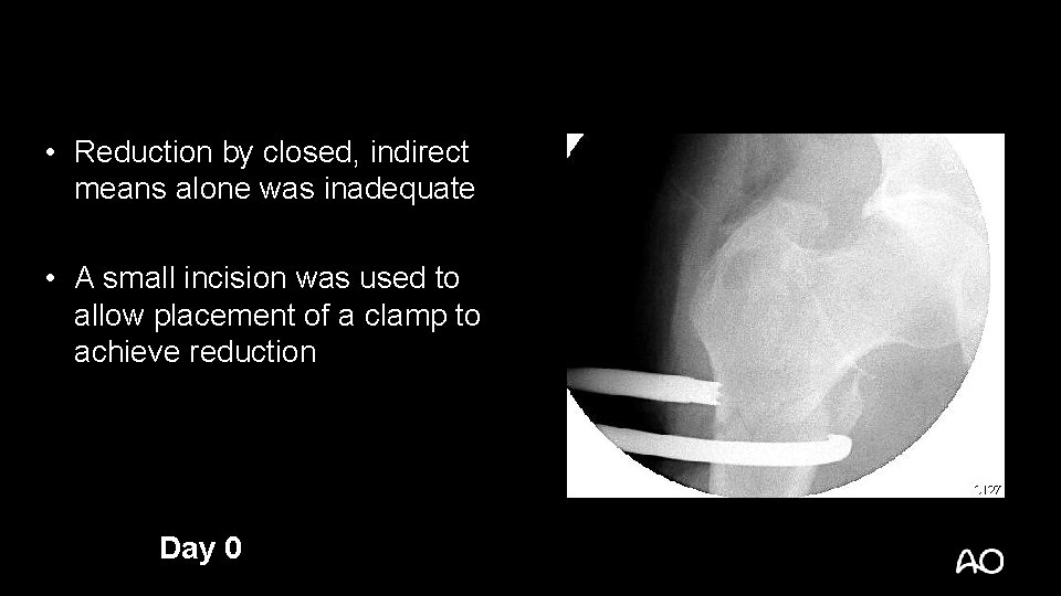  • Reduction by closed, indirect means alone was inadequate • A small incision
