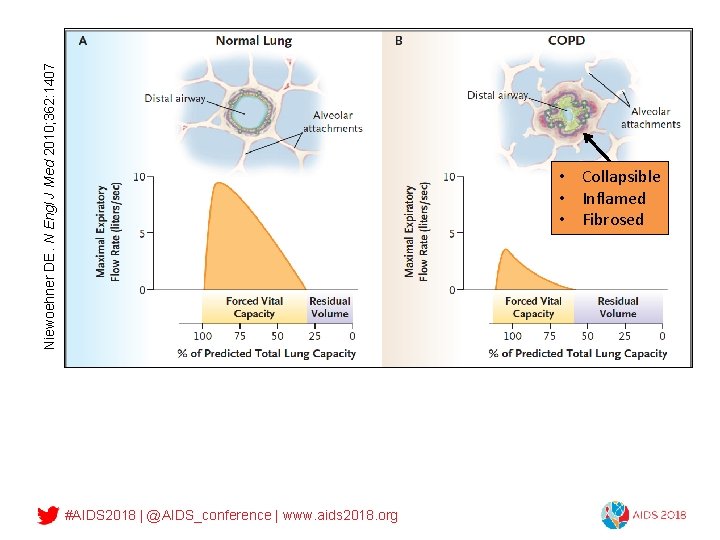 Niewoehner DE. N Engl J Med 2010; 362: 1407 What is COPD? • Collapsible