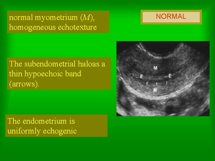 normal myometrium (M), homogeneous echotexture The subendometrial haloas a thin hypoechoic band (arrows). The