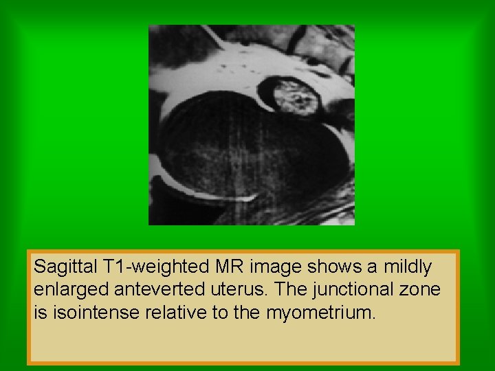 Sagittal T 1 -weighted MR image shows a mildly enlarged anteverted uterus. The junctional