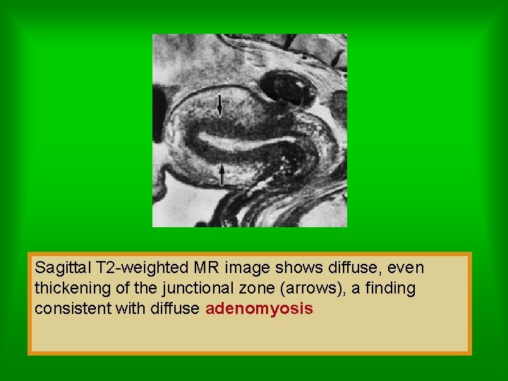 Sagittal T 2 -weighted MR image shows diffuse, even thickening of the junctional zone