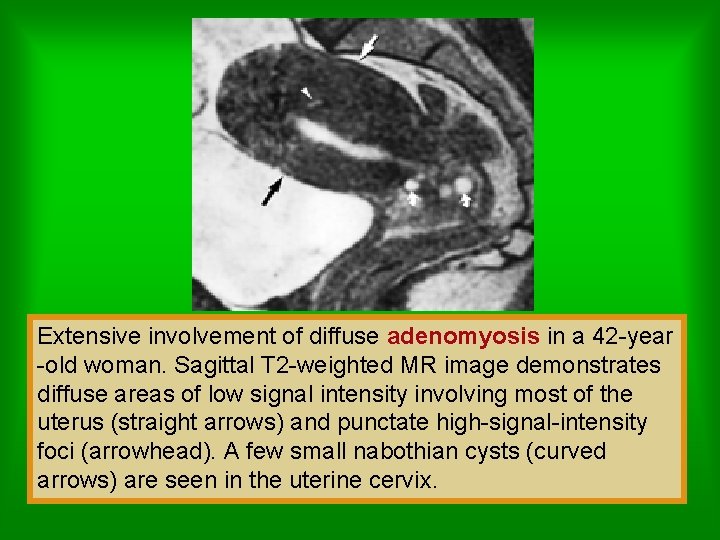 Extensive involvement of diffuse adenomyosis in a 42 -year -old woman. Sagittal T 2