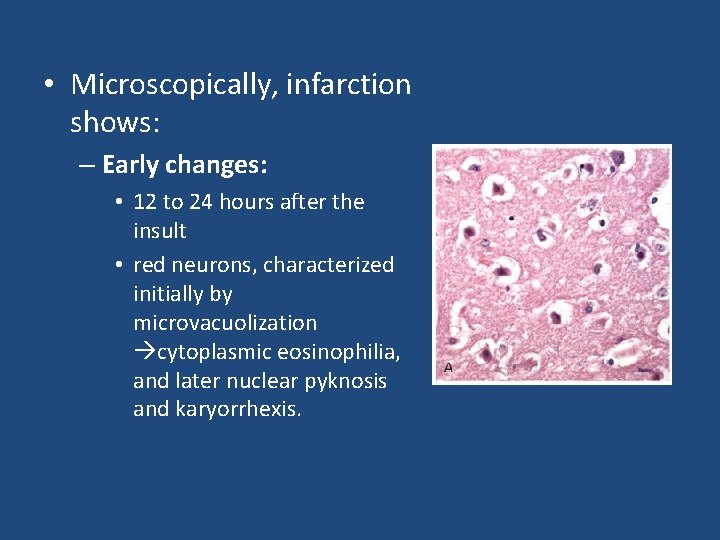  • Microscopically, infarction shows: – Early changes: • 12 to 24 hours after