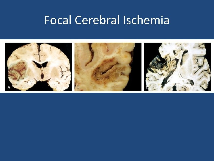 Focal Cerebral Ischemia 