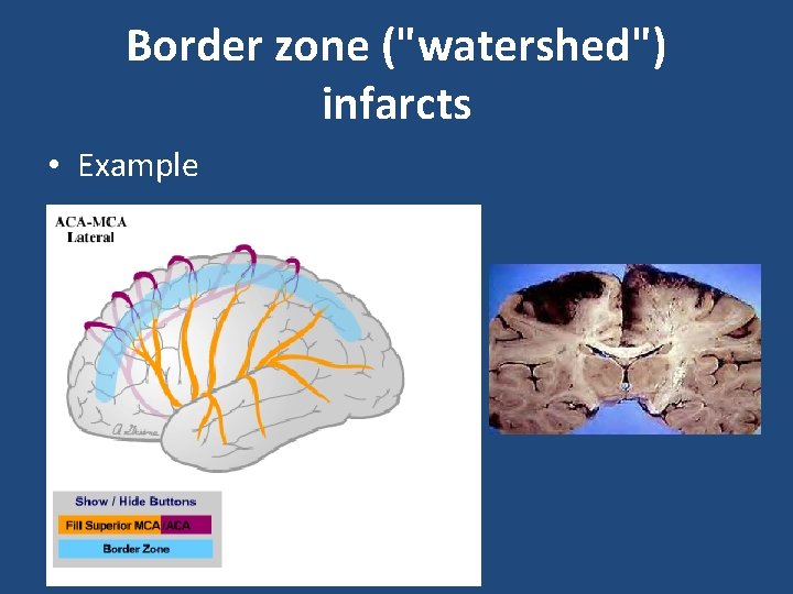 Border zone ("watershed") infarcts • Example 