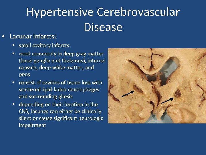 Hypertensive Cerebrovascular Disease • Lacunar infarcts: • small cavitary infarcts • most commonly in