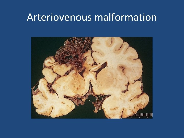 Arteriovenous malformation 