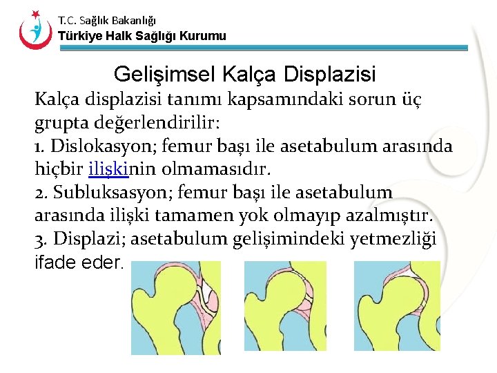 T. C. Sağlık Bakanlığı Türkiye Halk Sağlığı Kurumu Gelişimsel Kalça Displazisi Kalça displazisi tanımı