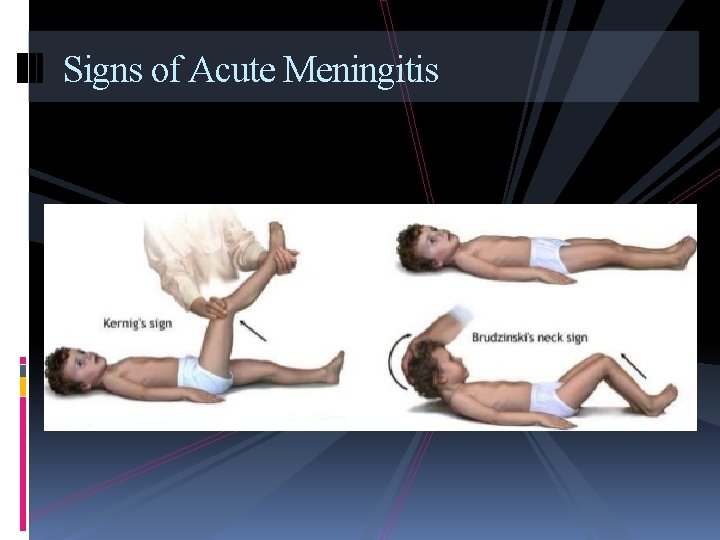 Signs of Acute Meningitis 