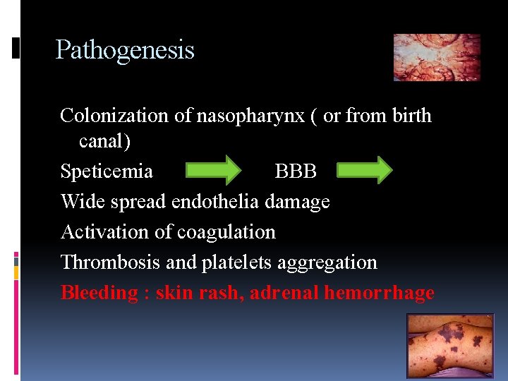 Pathogenesis Colonization of nasopharynx ( or from birth canal) Speticemia BBB Wide spread endothelia