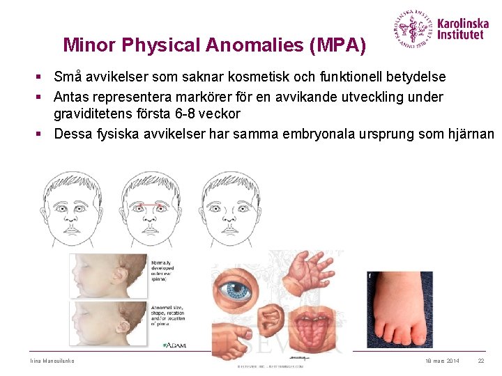 Minor Physical Anomalies (MPA) § Små avvikelser som saknar kosmetisk och funktionell betydelse §