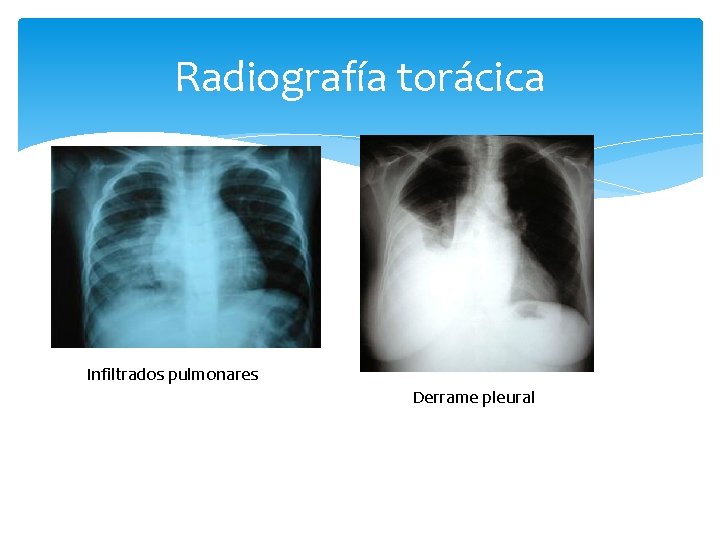 Radiografía torácica Infiltrados pulmonares Derrame pleural 