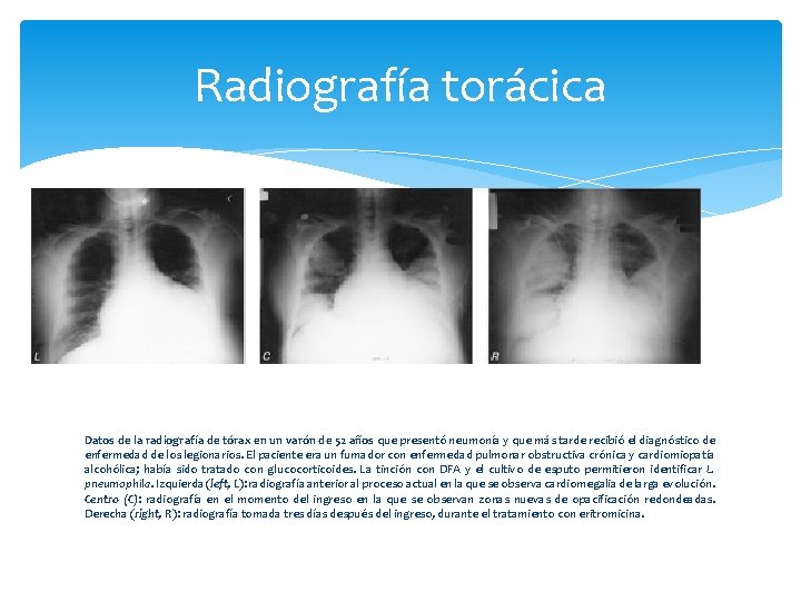 Radiografía torácica Datos de la radiografía de tórax en un varón de 52 años