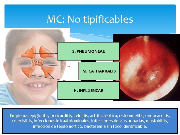 MC: No tipificables S. PNEUMONEAE M. CATHARRALIS H. INFLUENZAE Empiema, epiglotitis, pericarditis, celulitis, artritis