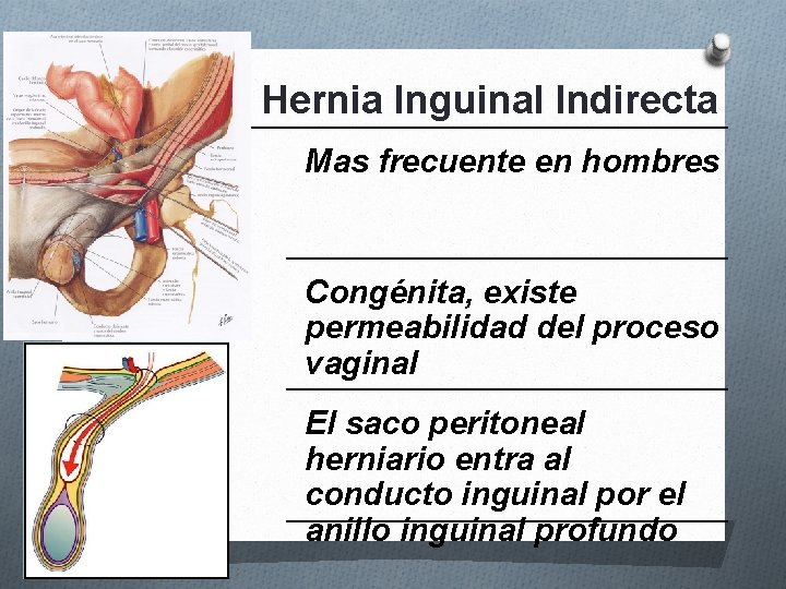 Hernia Inguinal Indirecta Mas frecuente en hombres Congénita, existe permeabilidad del proceso vaginal El