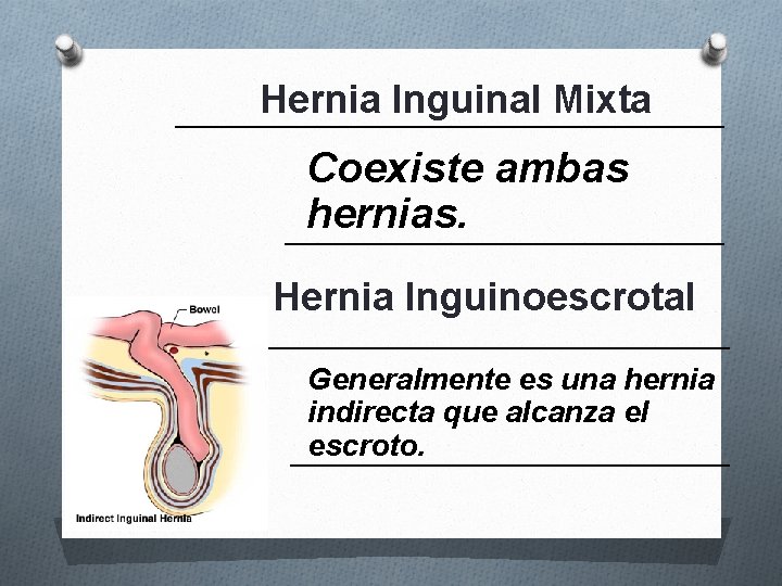 Hernia Inguinal Mixta Coexiste ambas hernias. Hernia Inguinoescrotal Generalmente es una hernia indirecta que