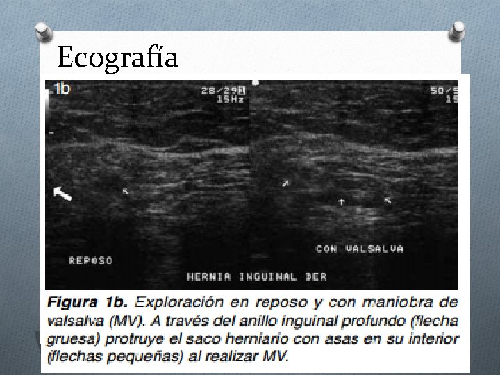 Ecografía 
