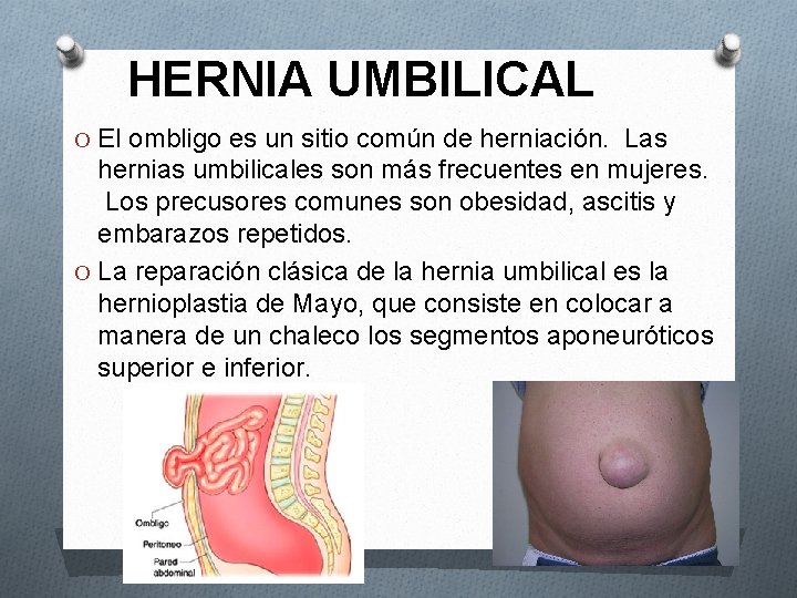 HERNIA UMBILICAL O El ombligo es un sitio común de herniación. Las hernias umbilicales
