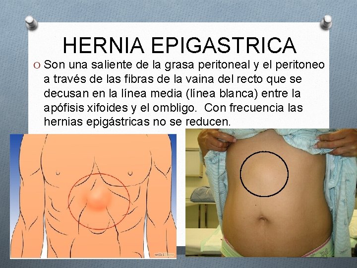 HERNIA EPIGASTRICA O Son una saliente de la grasa peritoneal y el peritoneo a